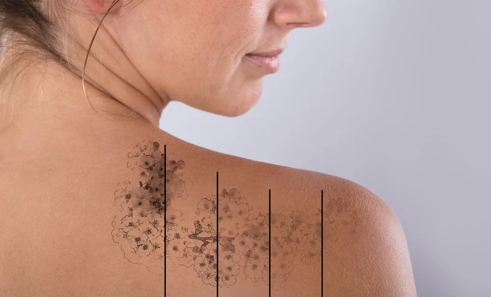 What is the Best Guide for Tattoo Removal in Chennai?