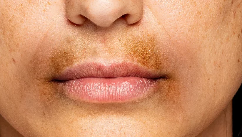 How to Cure Hyperpigmentaion Around Mouth Permanently?